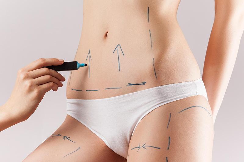 Abdominoplastie